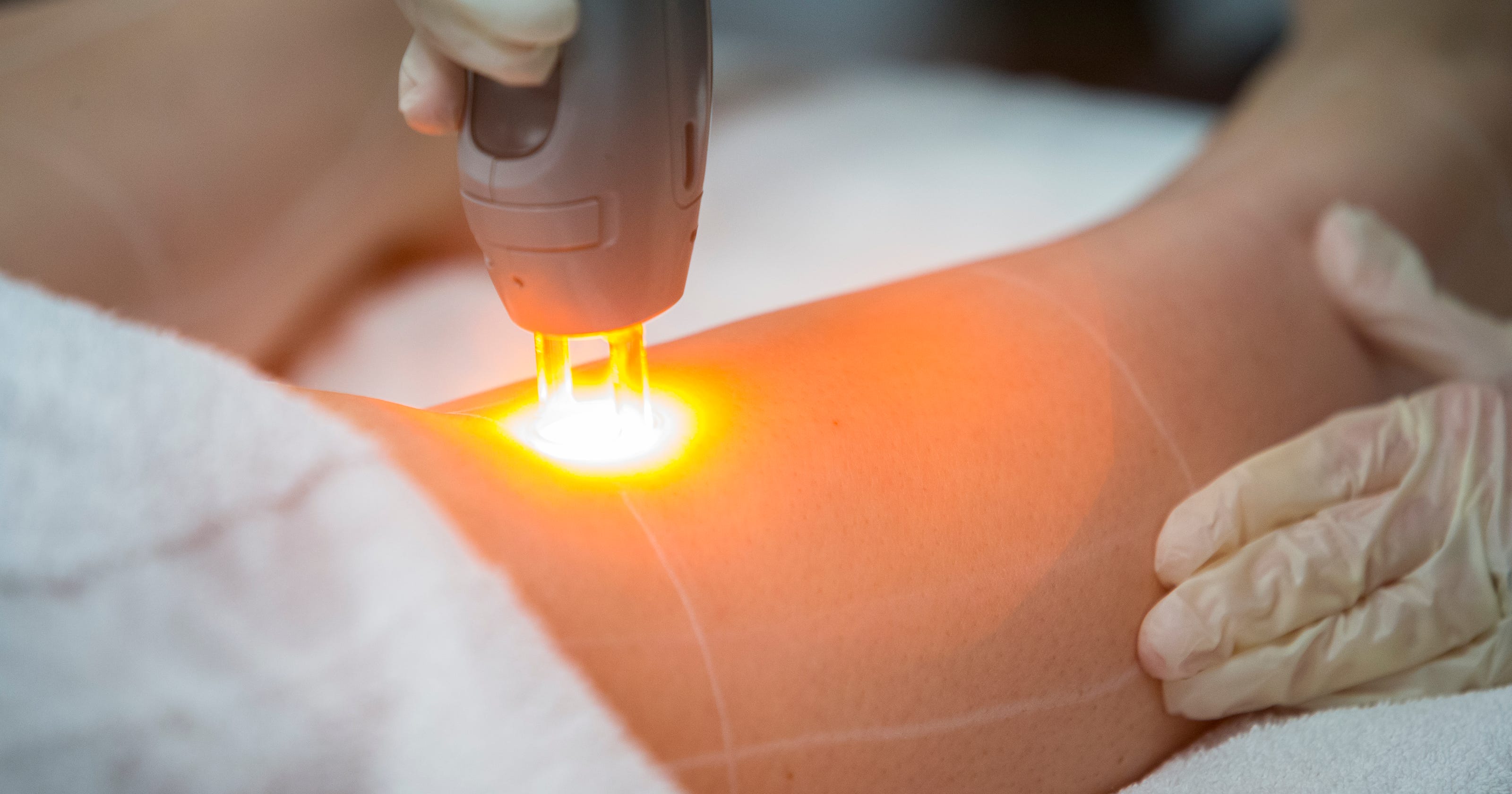 Risk Of Botched Laser Job Runs High