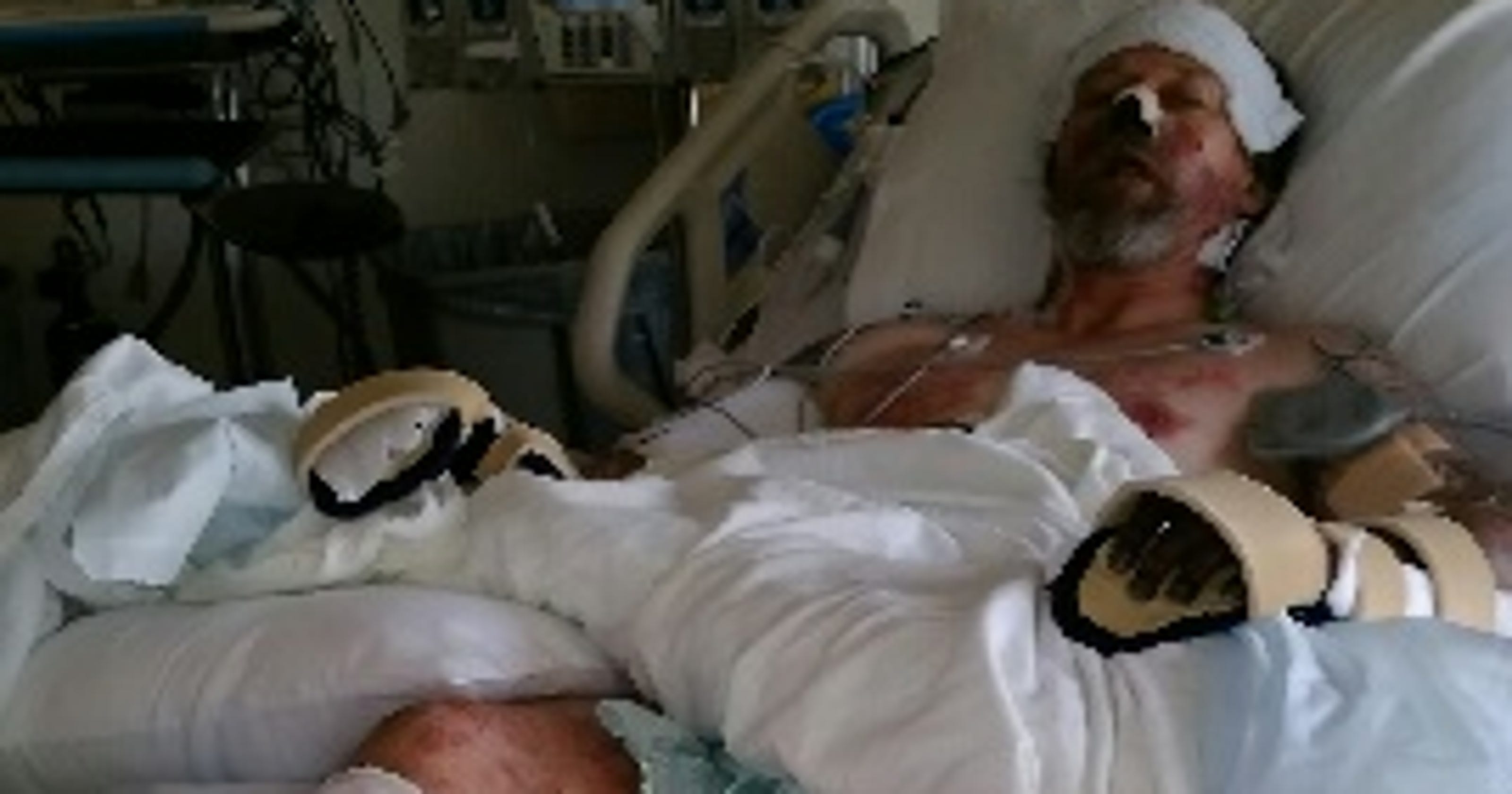 Man determined to walk after infection from dog photo