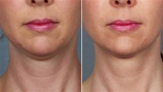 An FDA panel recommends a drug for approval that would "melt" your double chin.