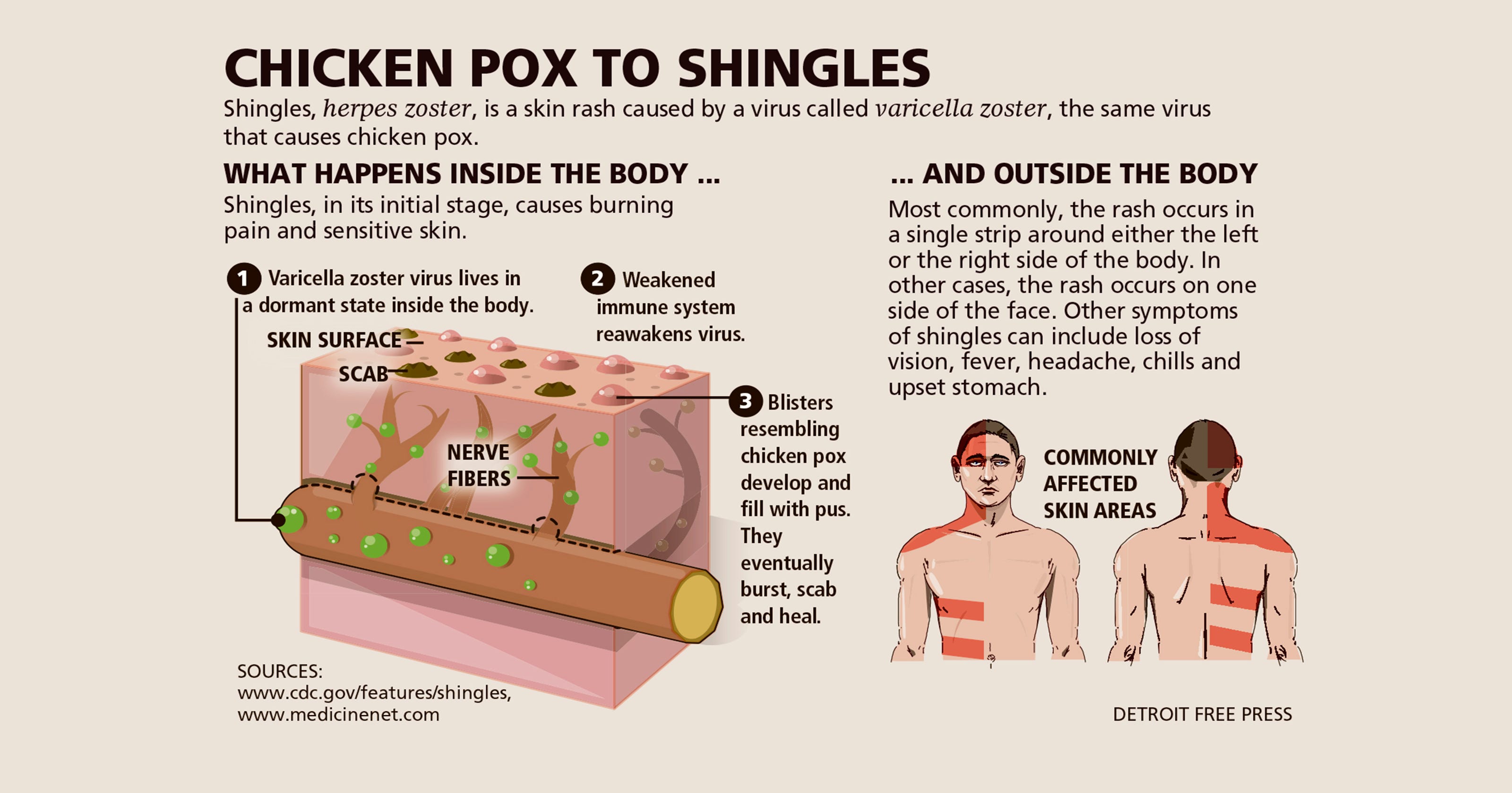 Does heat help shingles nerve pain?