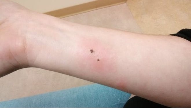 Muskegon woman hospitalized after brown recluse spider bite