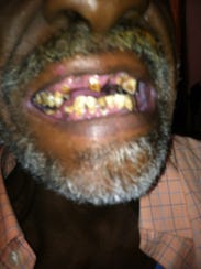 Many of Edward Redmond's top teeth are missing.