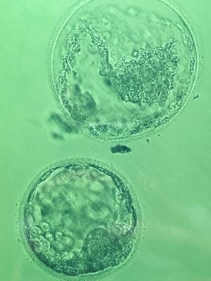 2 embryos used for Angela Pease's transfer on May 26, 2015.