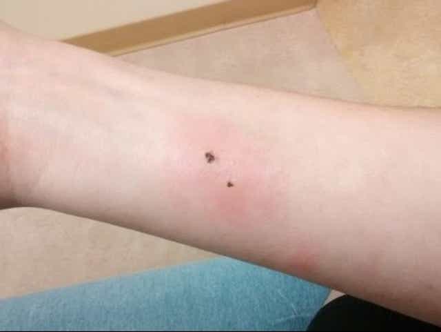 Muskegon Woman Hospitalized After Brown Recluse Spider Bite