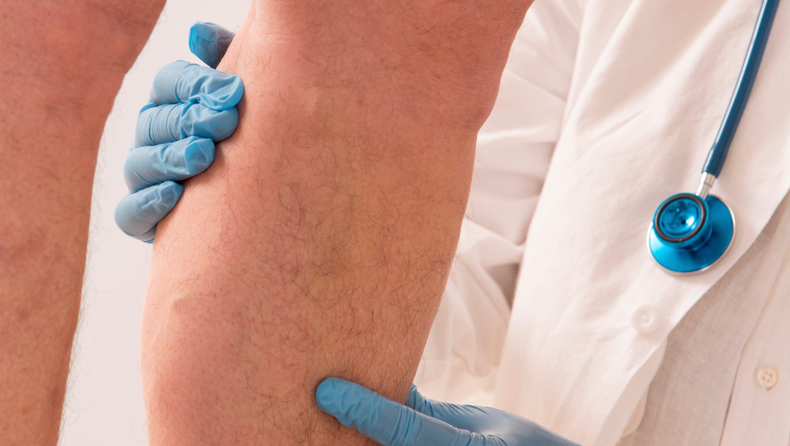 Get to know what chronic venous insufficiency is and how to help it