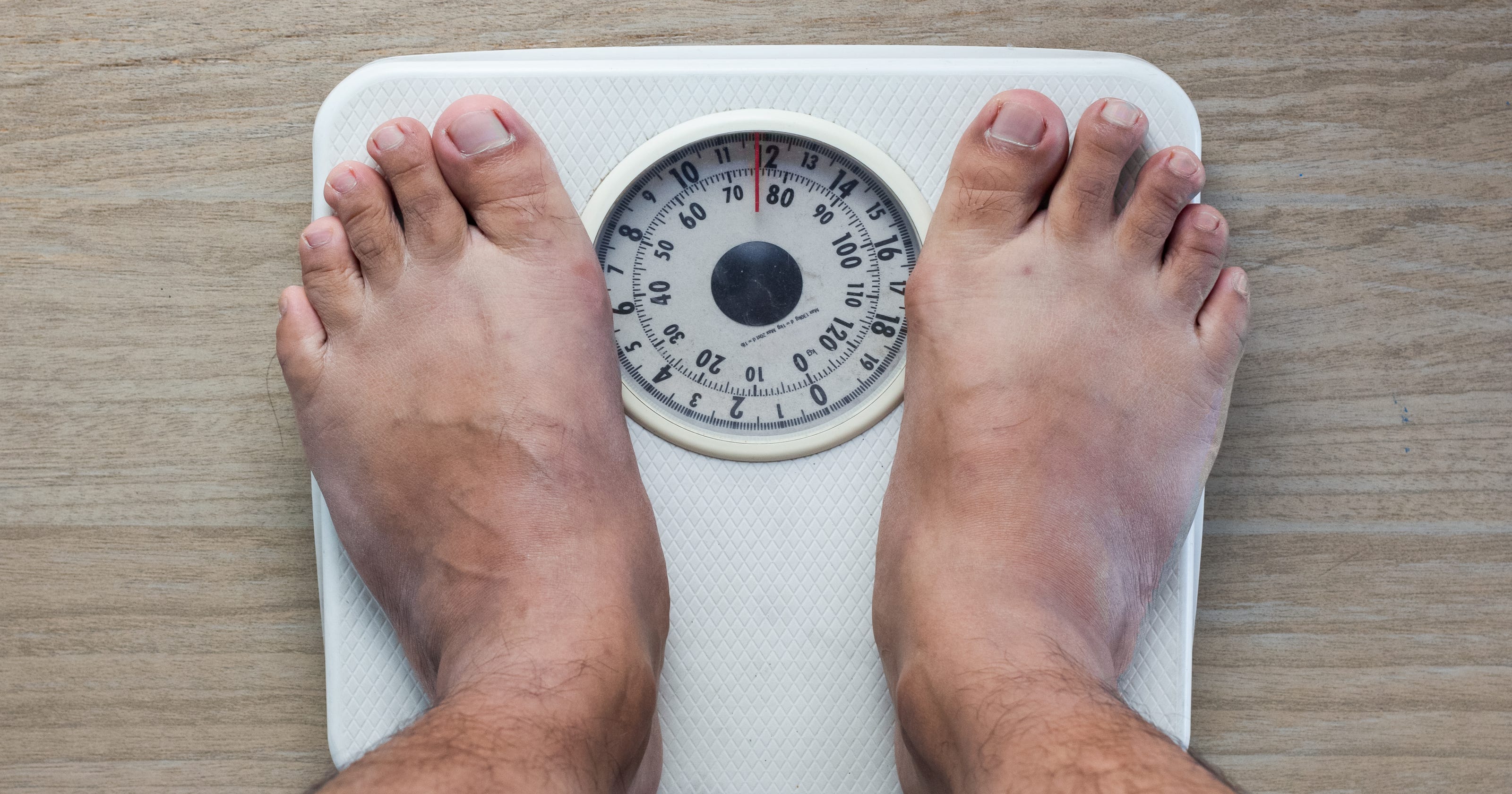 Extreme Weight Loss Brings Extreme Problems