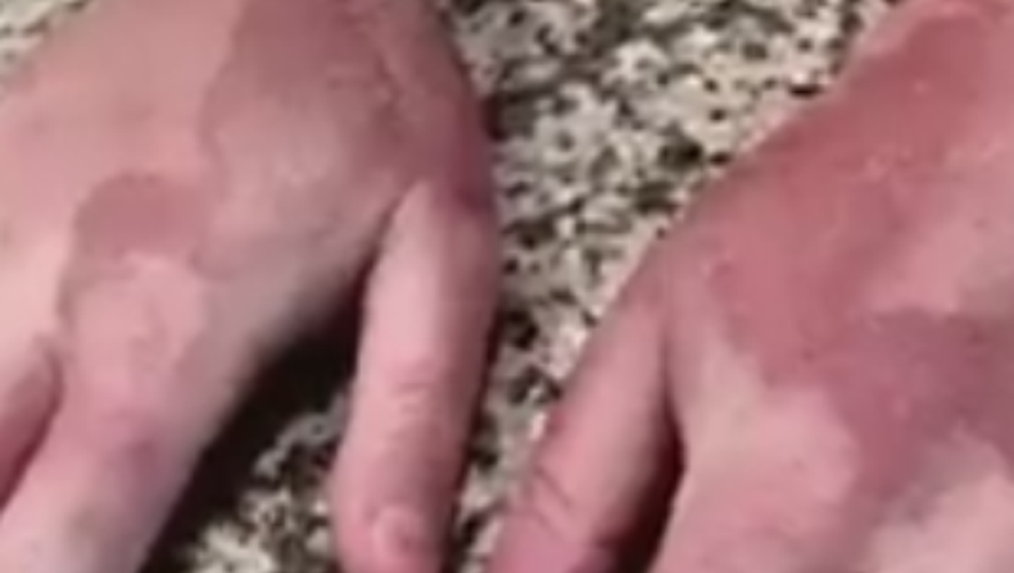 Margarita Dermatitis? Man gets seconddegree burns from lime juice, sun