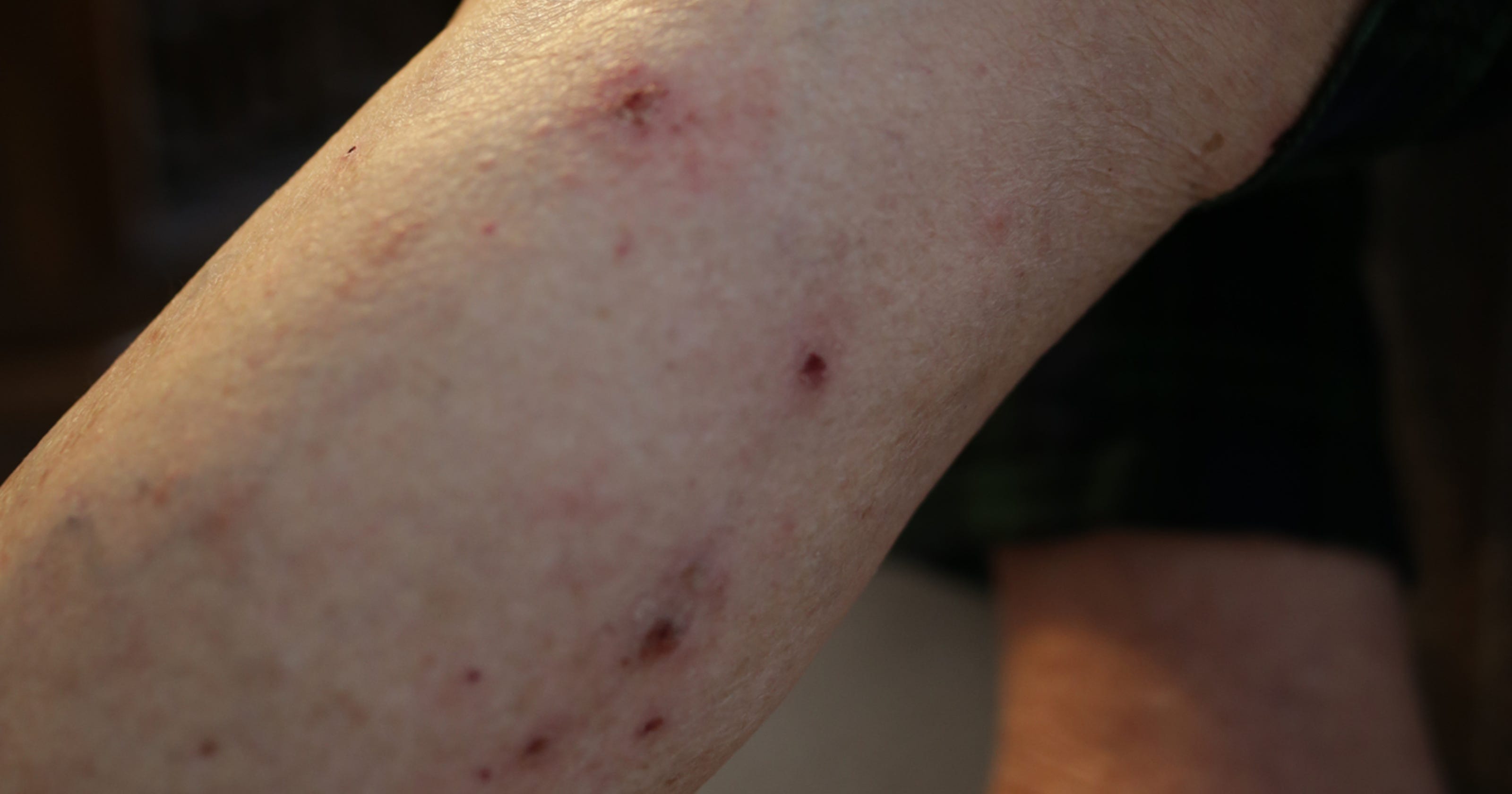 Emails show feds knew of rashes in Flint in mid2014