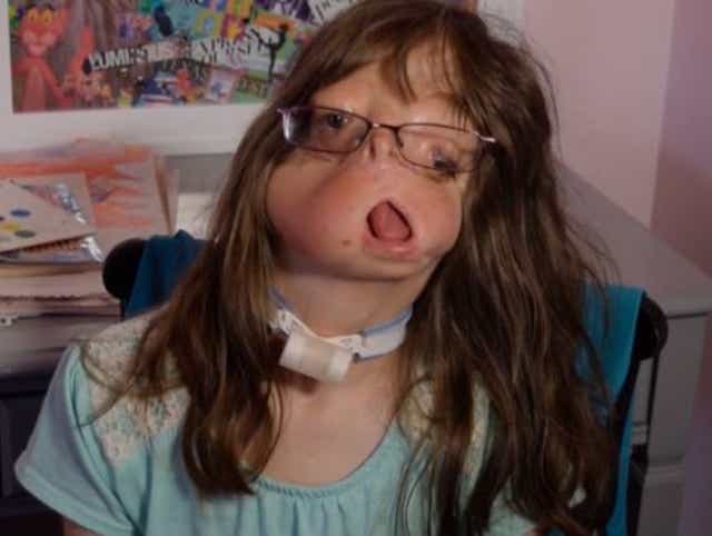 Girl Born Without A Face Finds Sister Across The World
