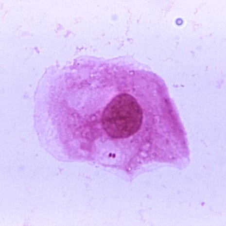 Neisseria meningitidis.