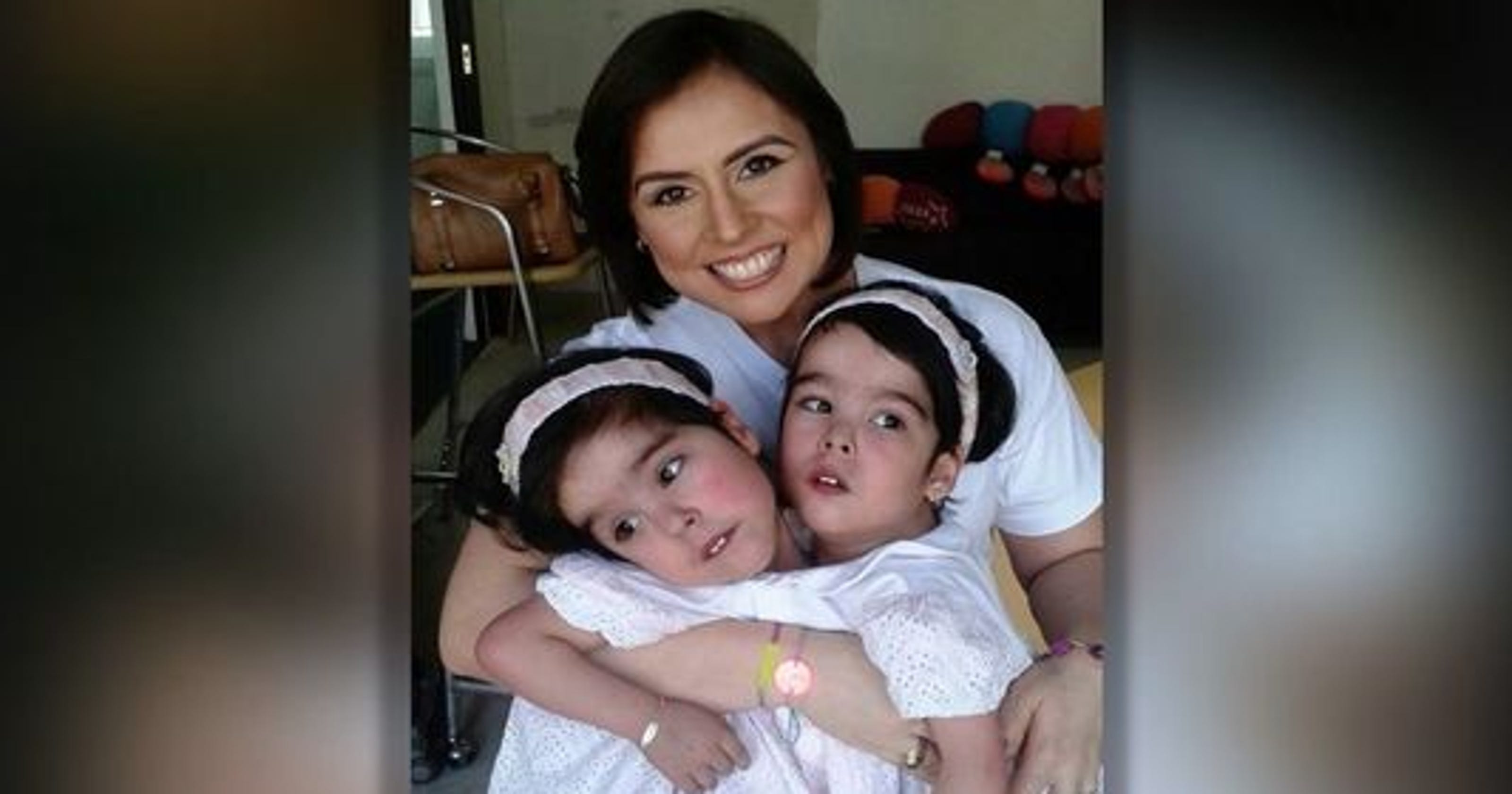 Conjoined Twins Who Share Heart Need Surgery To Survive 