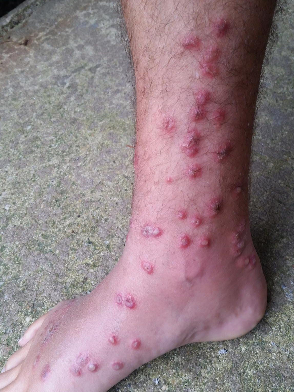 swimmers itch feet