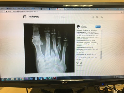 An X-ray on Kelly Slater's Instagram page shows his