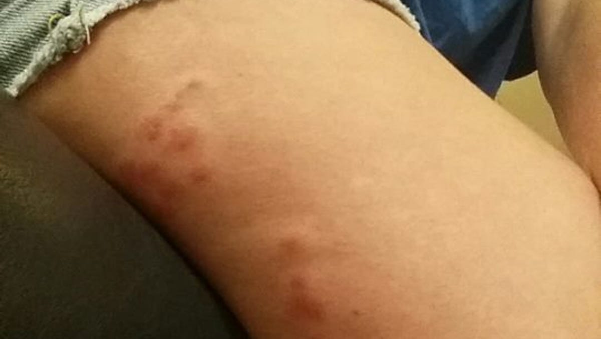 Insidious 'kissing bugs' bite Olney woman in Mason, Texas Insidious 'kissing bugs' bite Olney woman in Mason, Texas
