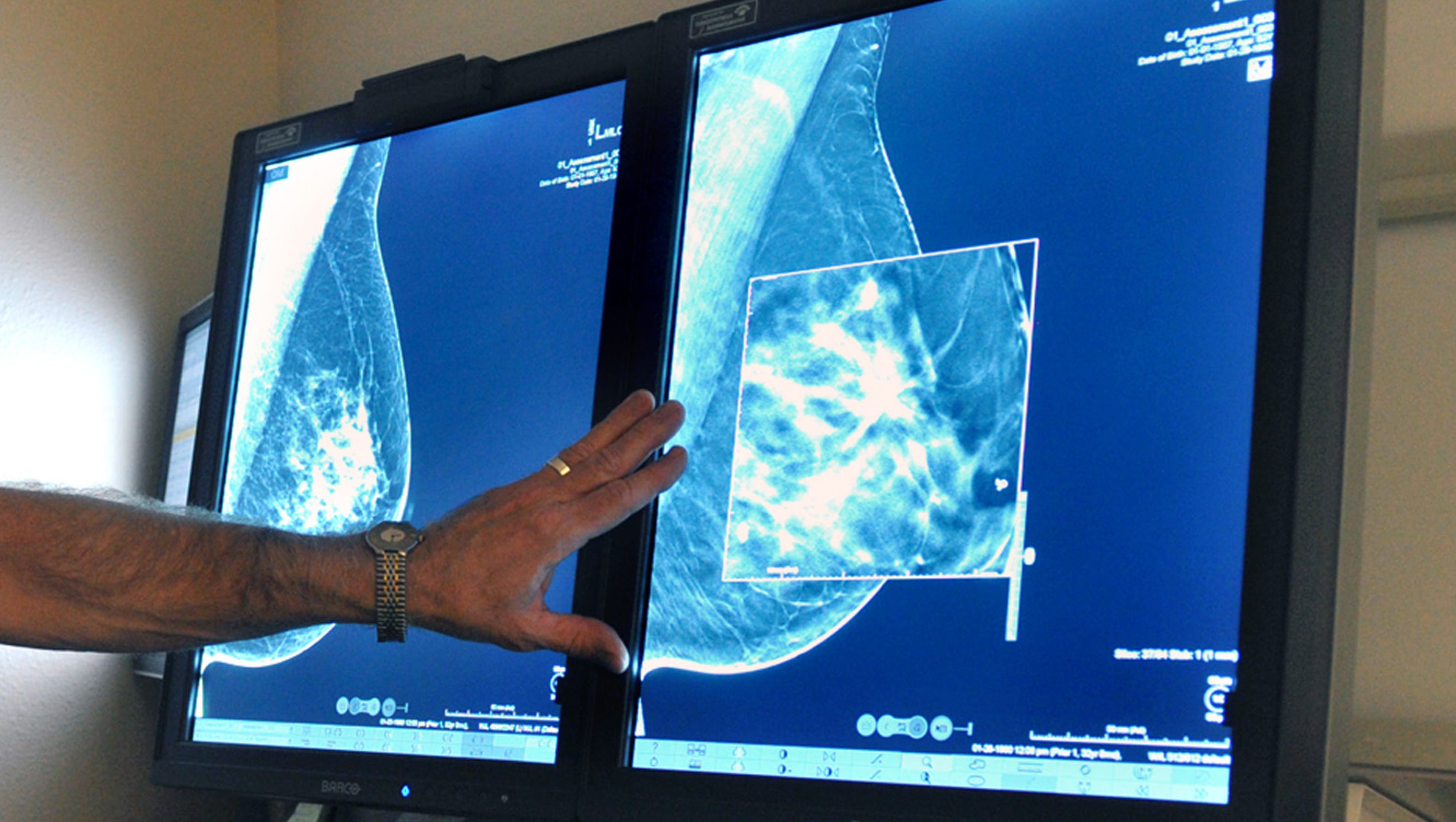 Breast cancer surgery healing process may trigger cancer ...
