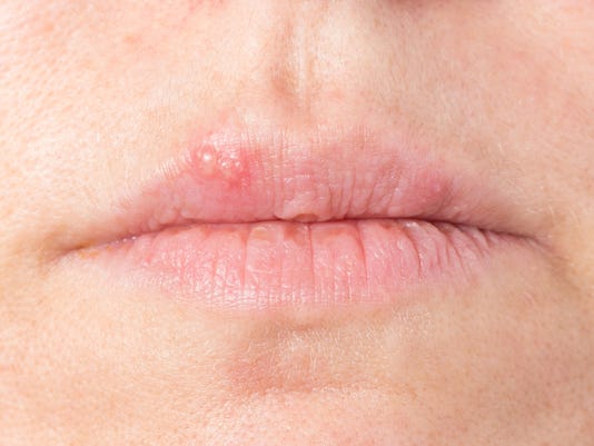 Cold Sores Symptoms Causes Treatment And More