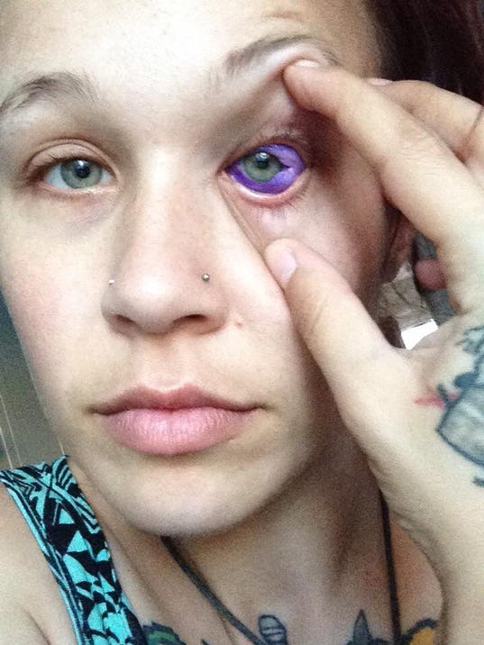 Sclera tattoo: Don't ink your eyeball. Just don't do it.