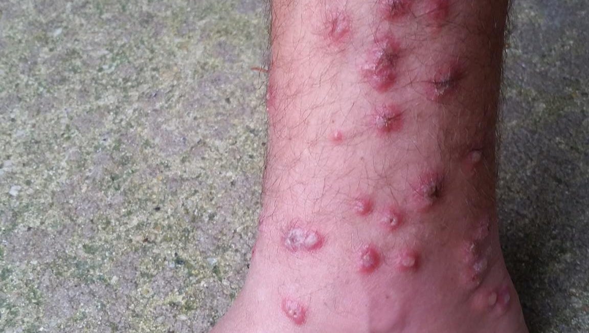 swimmers itch on feet swimmers itch on feet