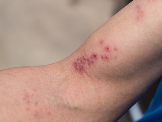 gabapentin dose in shingles