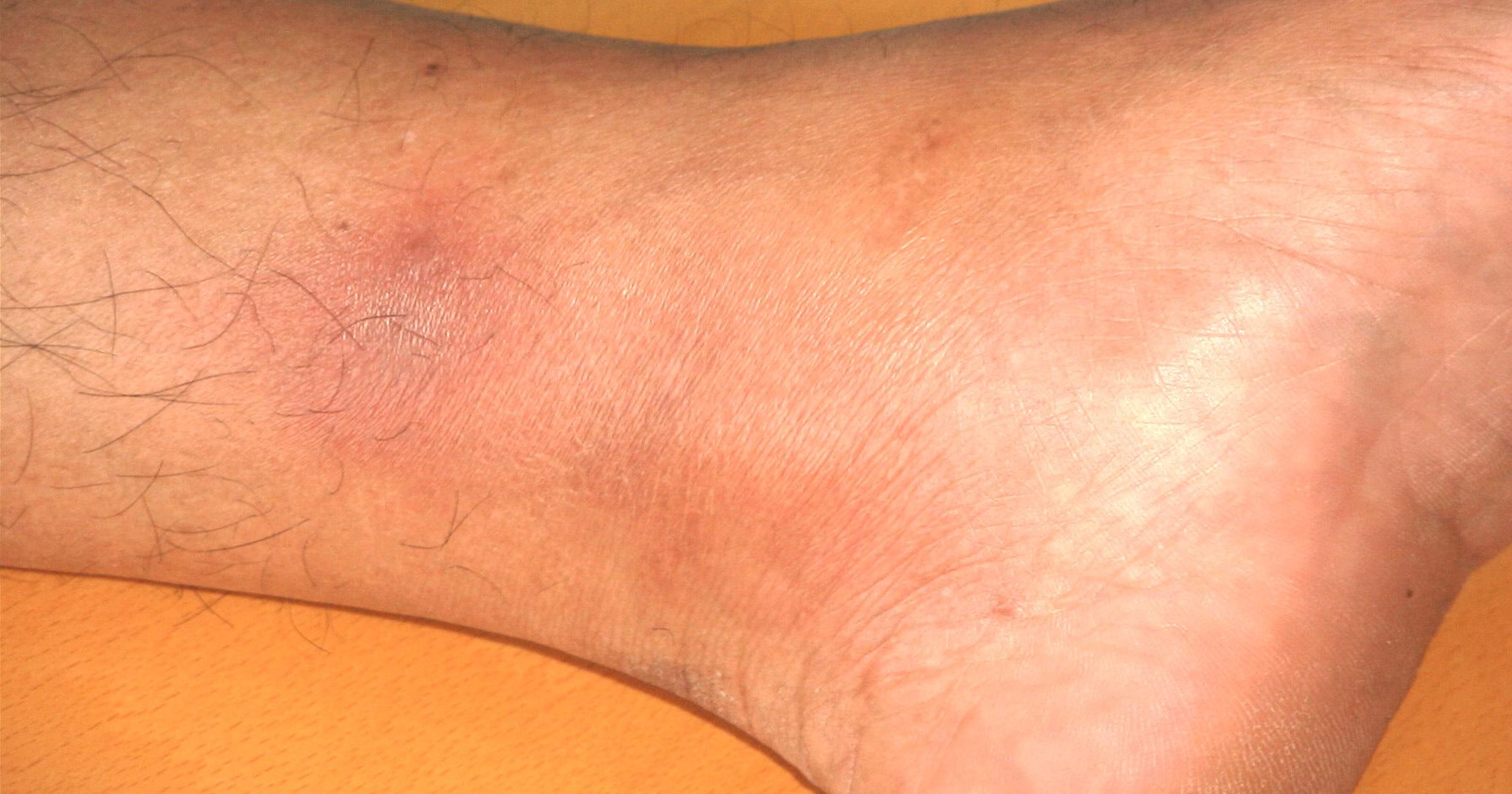 Mystery bruise disappears