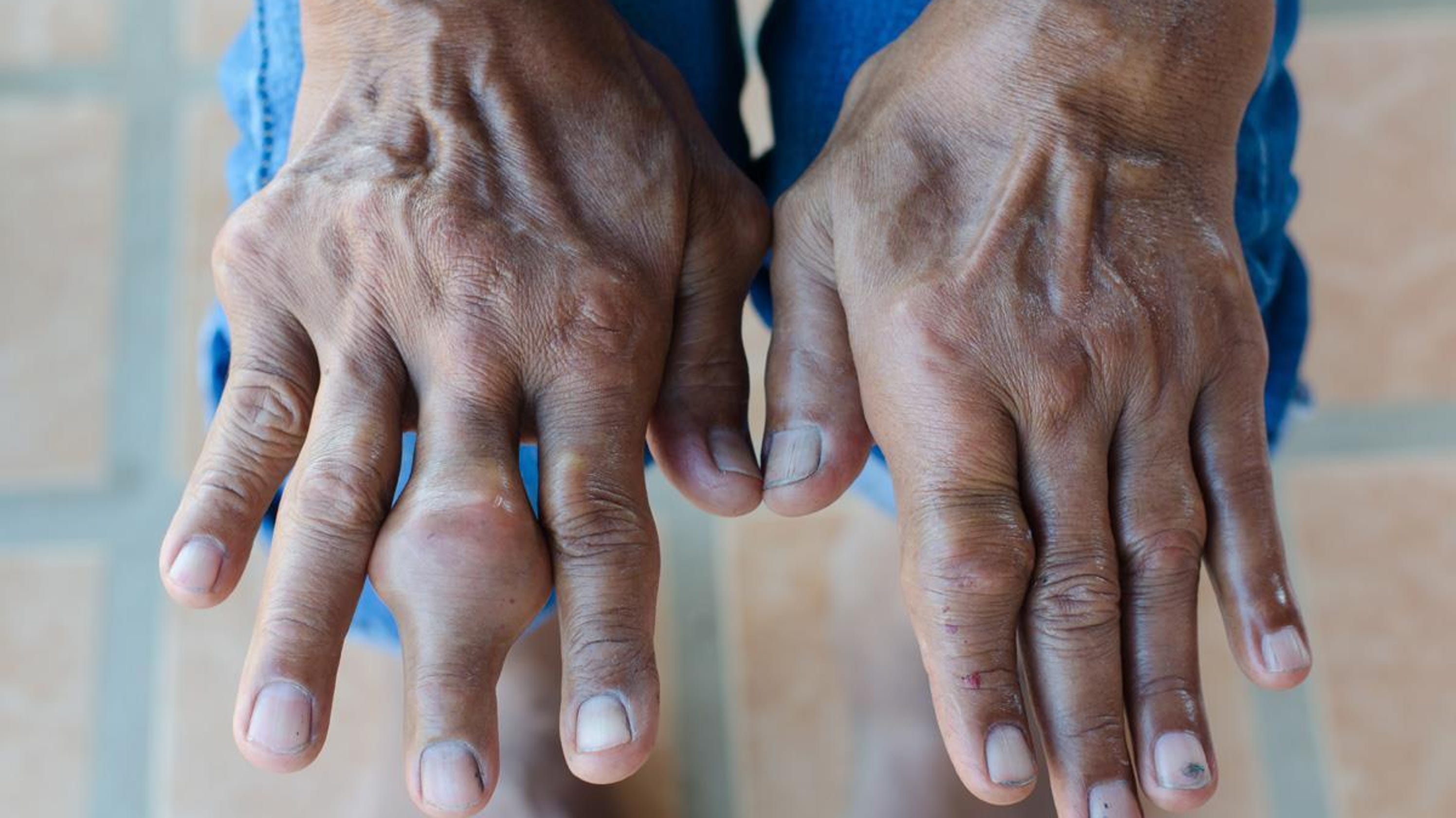 Gout, just a pain in the big toe?