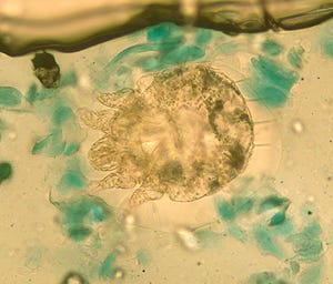 Scabies is a mite that burrows under the skin, causing a rash and irritation. Officials believe an outbreak at a Nashville jail may be affecting hundreds of inmates.