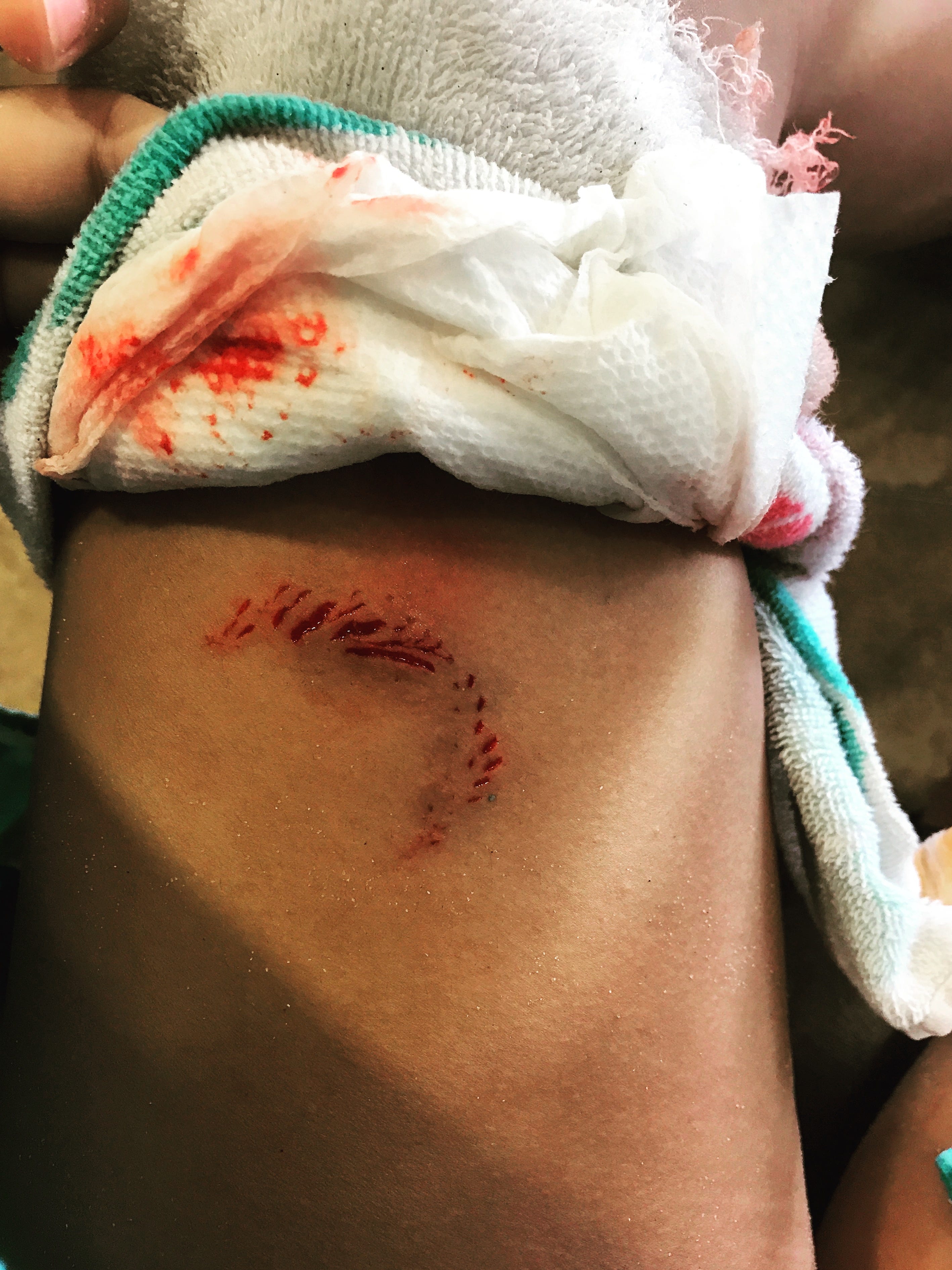Seymour Girl Bitten By Shark While Visiting St Simons Island Ga