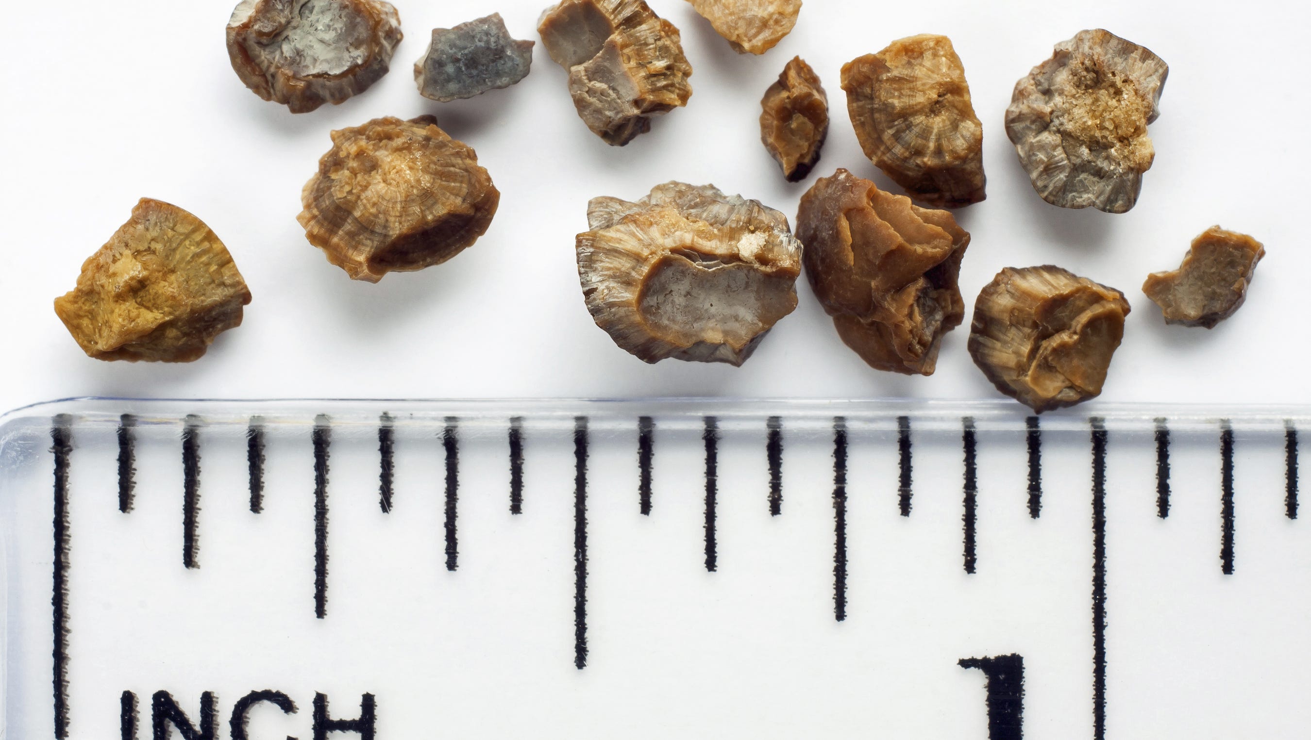 More Southerners At Risk For Kidney Stones