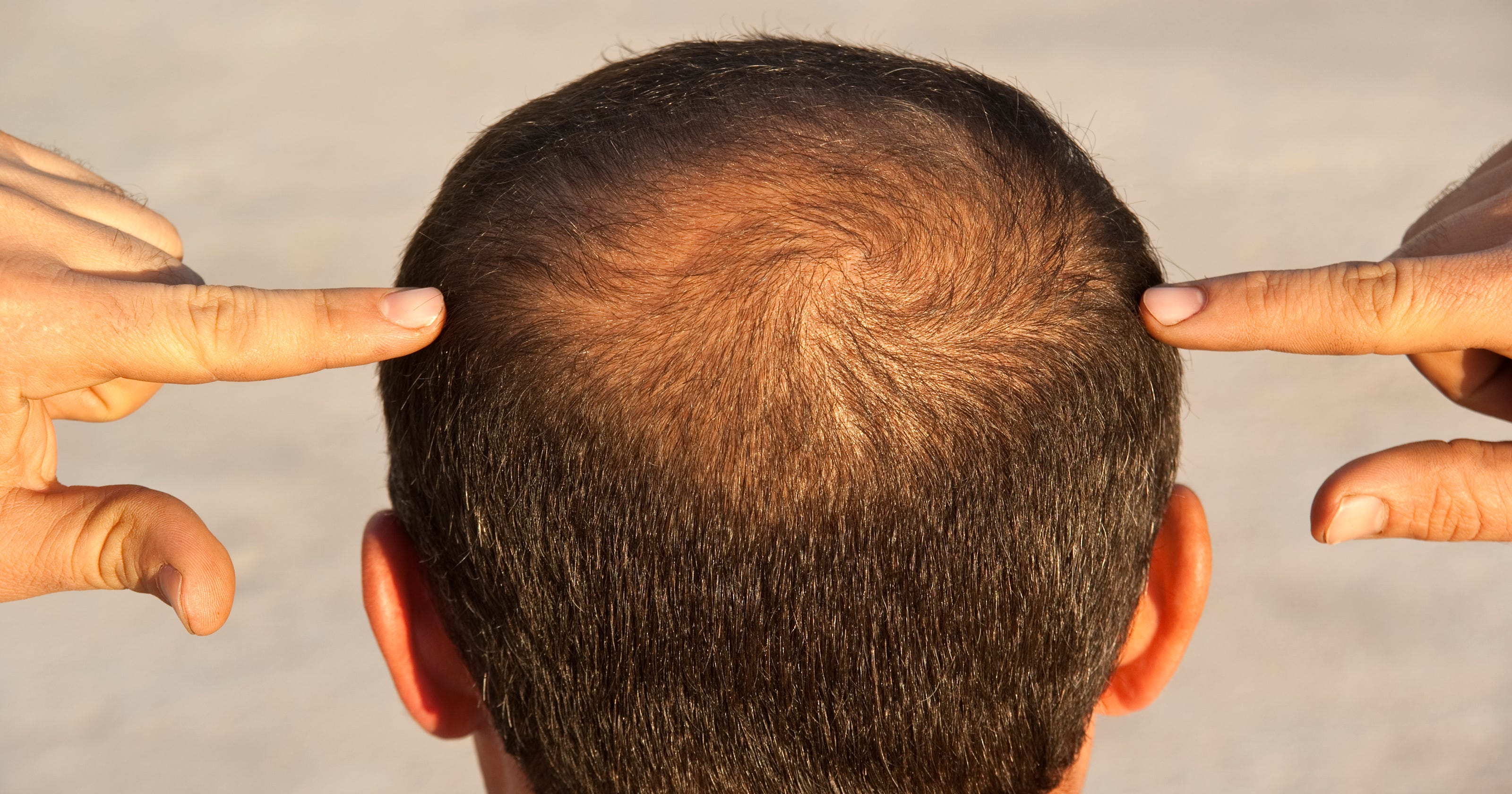 Baldness: An osteoporosis drug could help grow hair