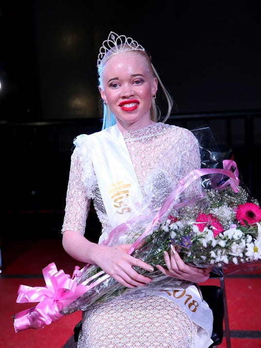 Miss Albino: Zimbabwe crowns first winner in bid to tackle ...