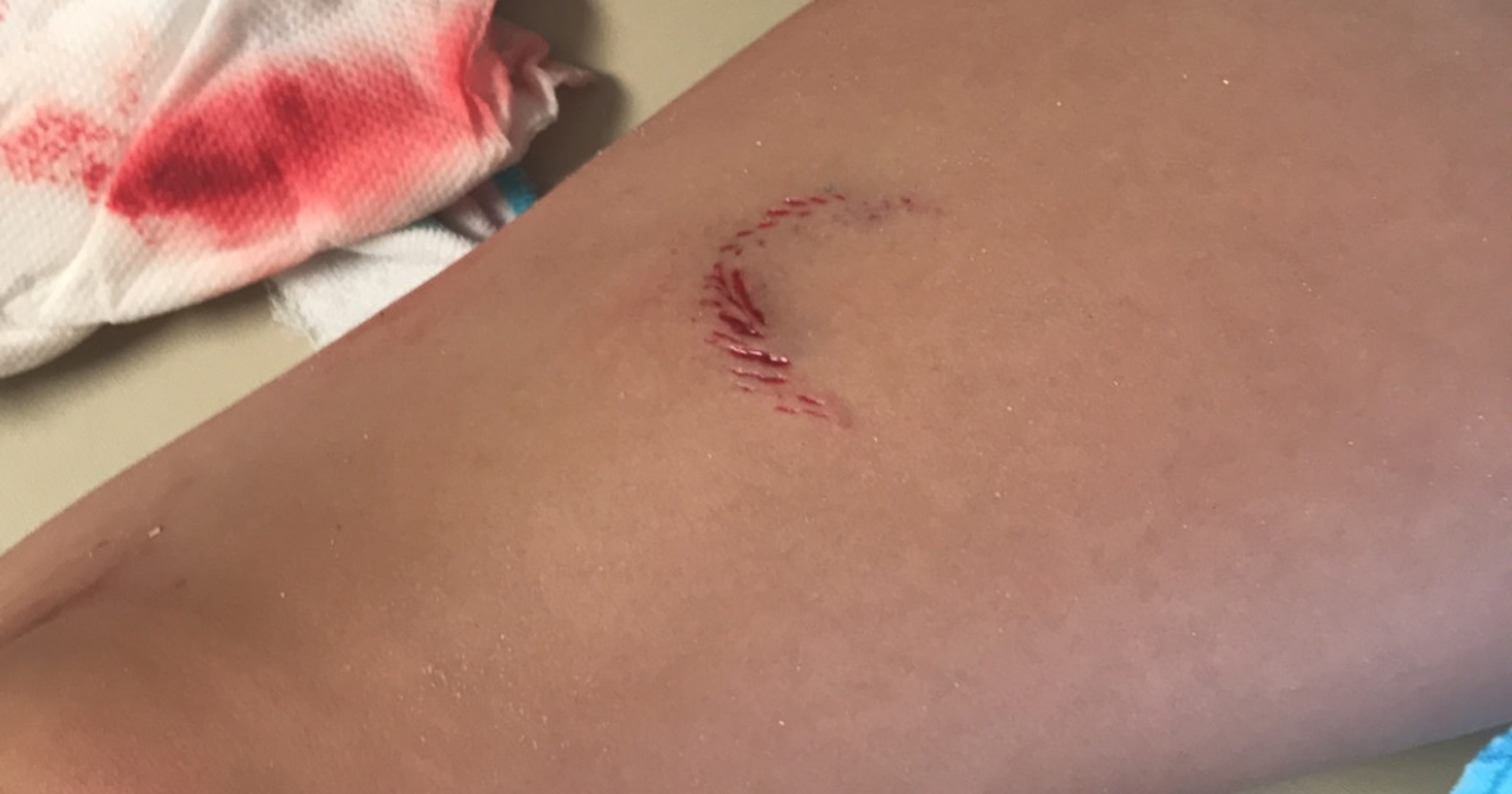 Seymour Girl Bitten By Shark While Visiting St Simons