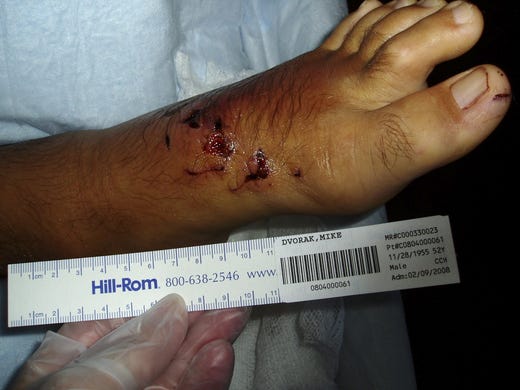 Shark bite victim Michael Dvorak's foot.