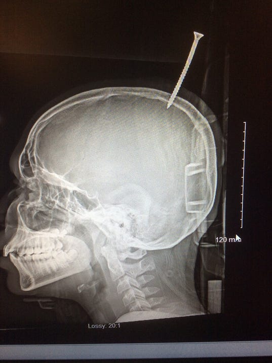 SCREW-LATERAL-SKULL-XRAY.JPG
