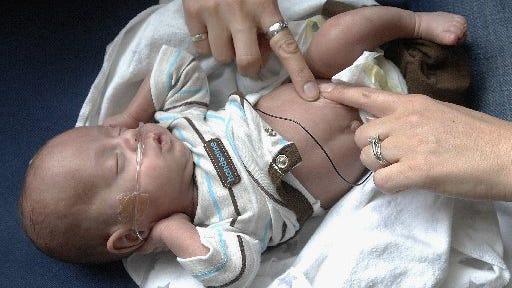The U.S. had the world's second-highest infant-mortality rate for premature babies born after 32 to 36 weeks — the period during which most preterm births occur.