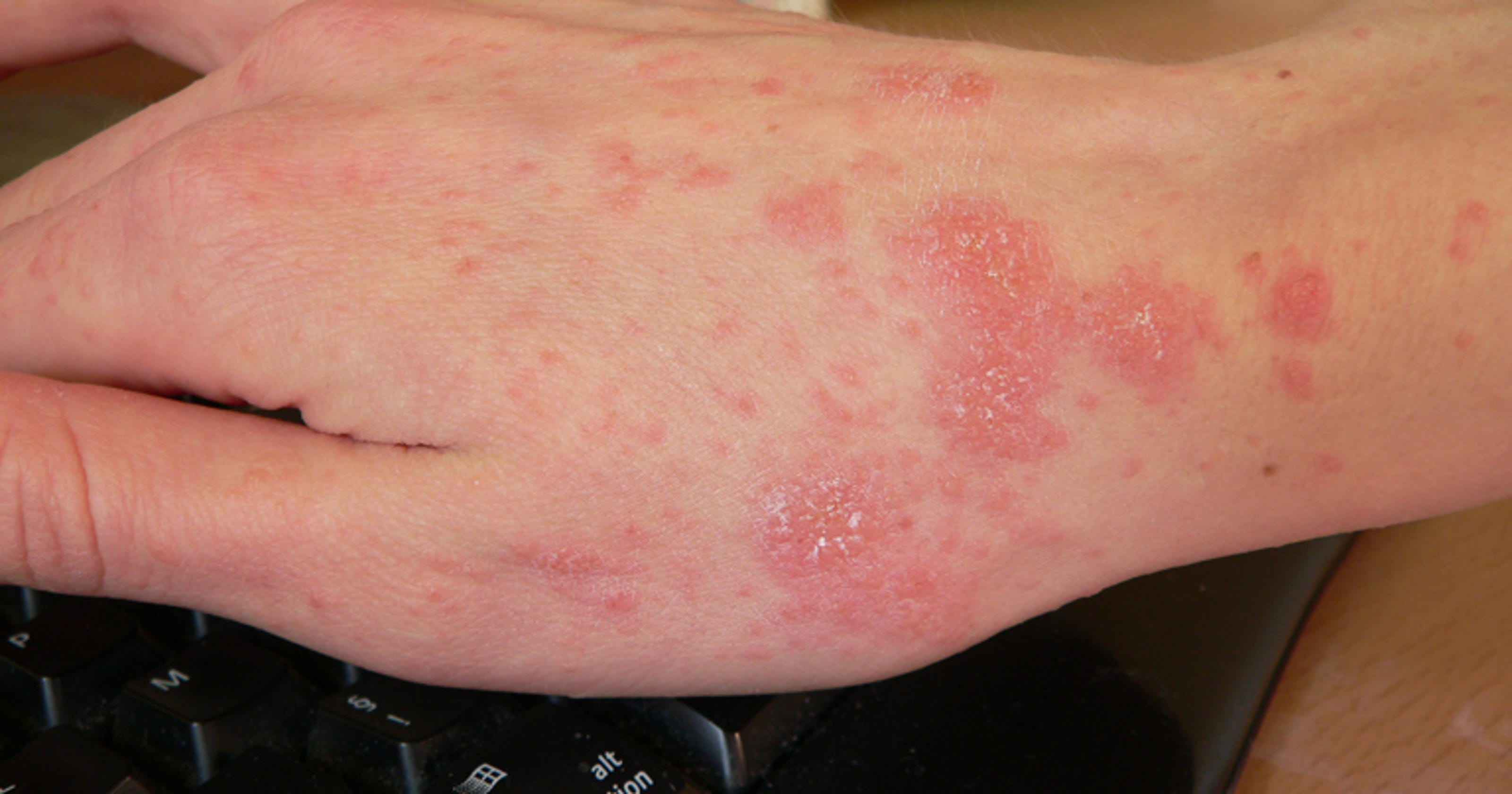 Asheville nursing home residents, staff treated for scabies