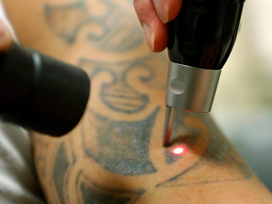 Tattoo removal takes laser leap forward