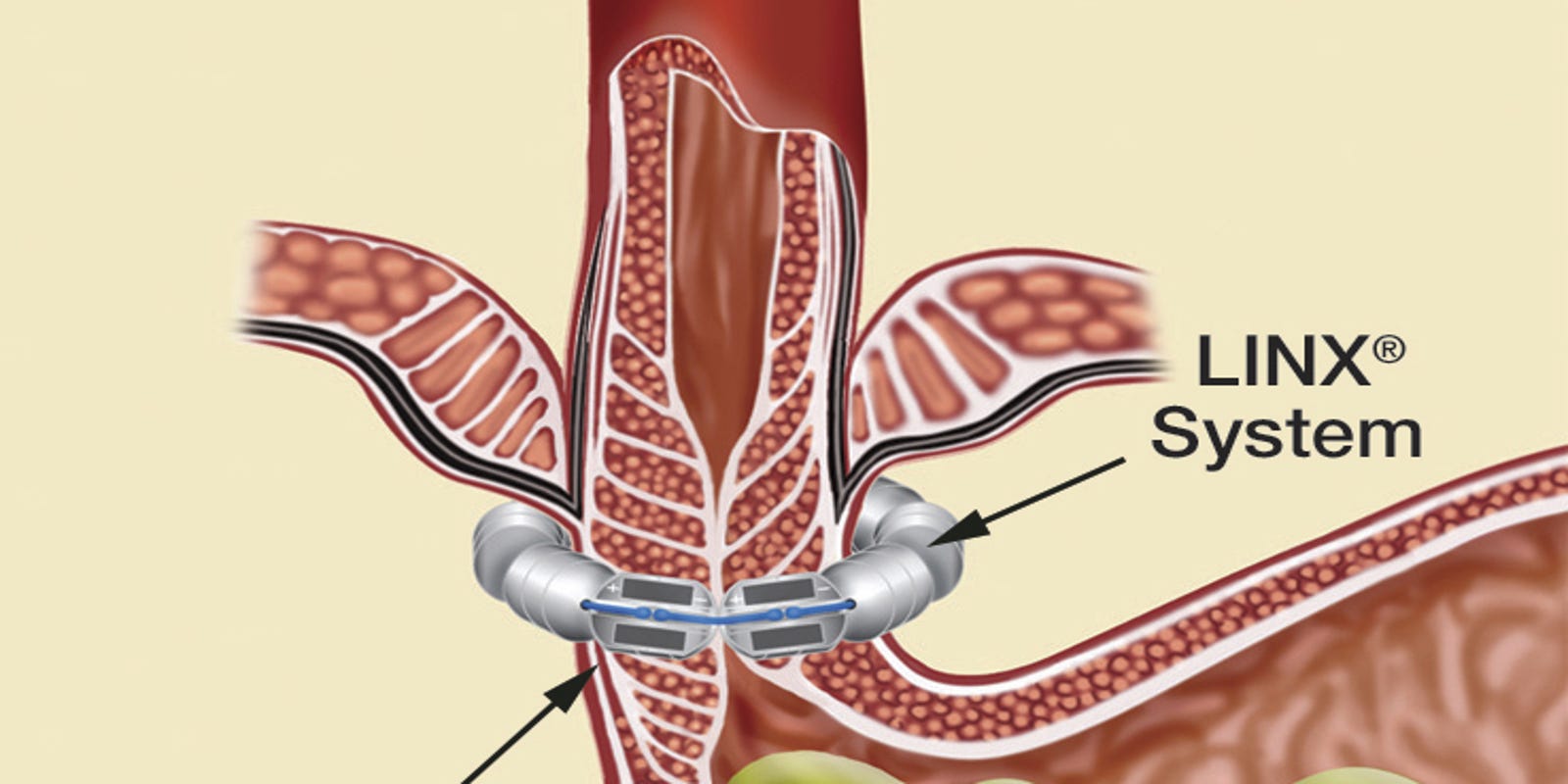 Acid reflux LINX procedure offers alternative to lifelong medication