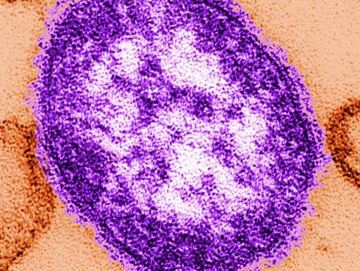 Putnam County was potentially exposed to measles, according to the New York&hellip;