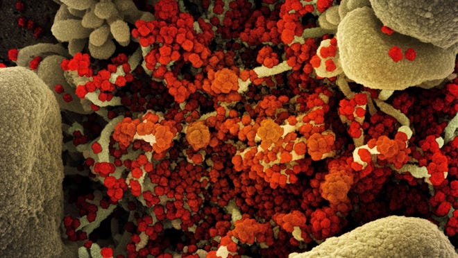 June 11, 2020, Fort Detrick, Maryland, USA: Colorized scanning electron micrograph of a cell heavily infected with SARS-CoV-2 virus particles (orange/red), isolated from a patient sample. The image was captured at the NIAID Integrated Research Facility (IRF).