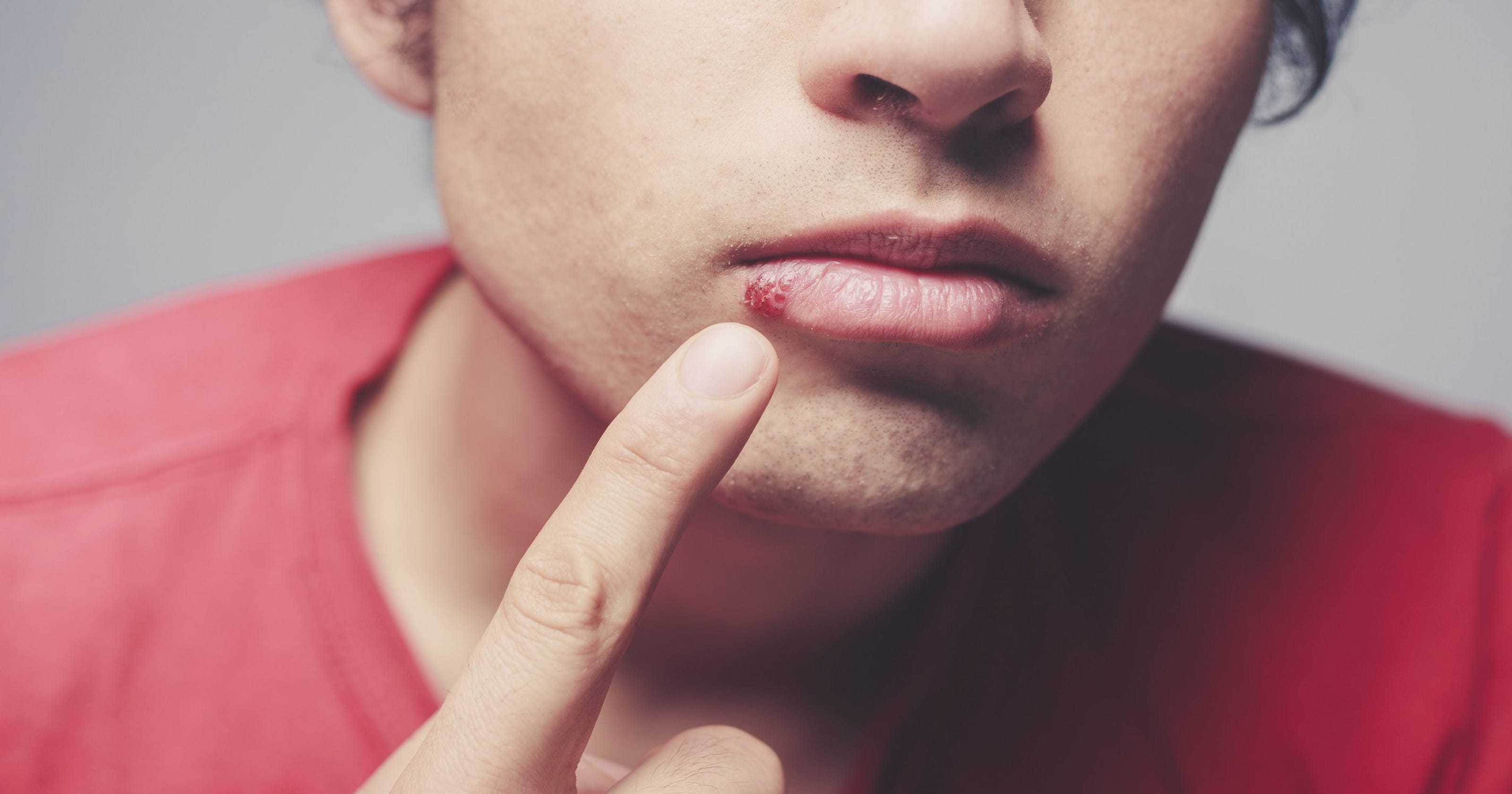 Winter Weather A Trigger For Cold Sores