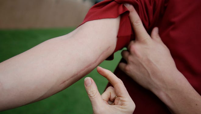 San Diego Padres and former Stanford pitcher Cal Quantrill  shows a scars on his elbow from Tommy John surgery during a team workout in Stanford, Calif. Tommy John III is hoping to reduce the need for the surgery.