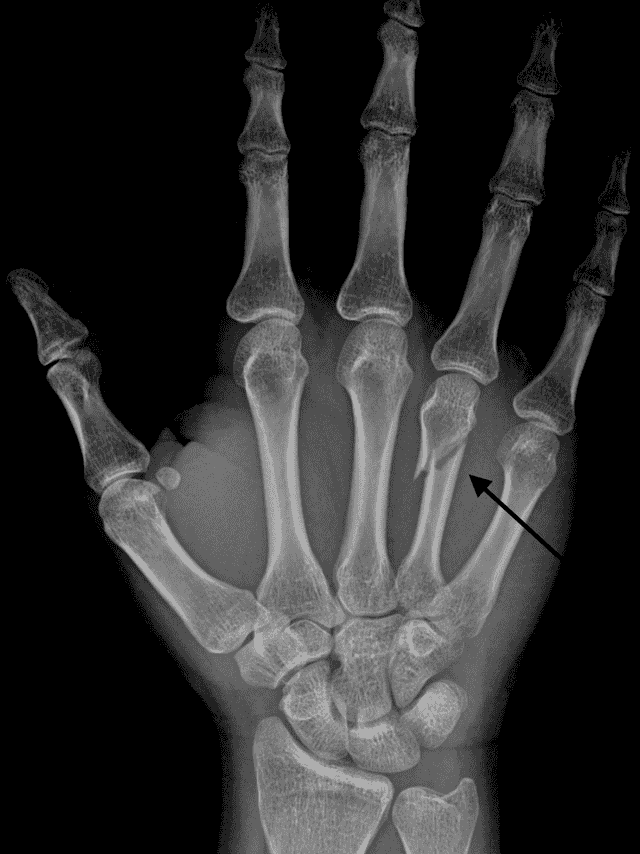 Can Hand Fractures Heal Quickly