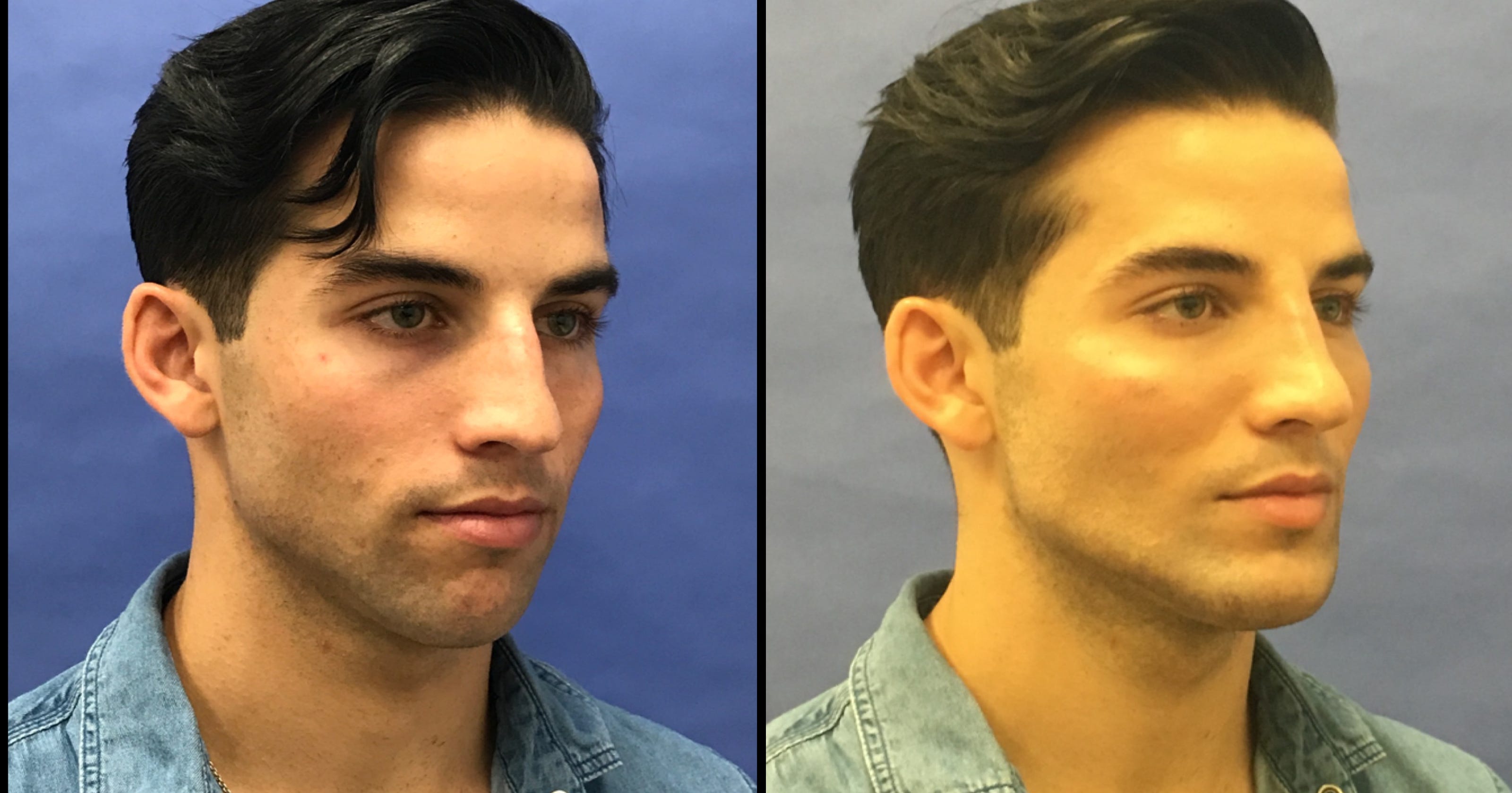 Men attracted to plastic surgery, from 'torso tucks" to hair transplants
