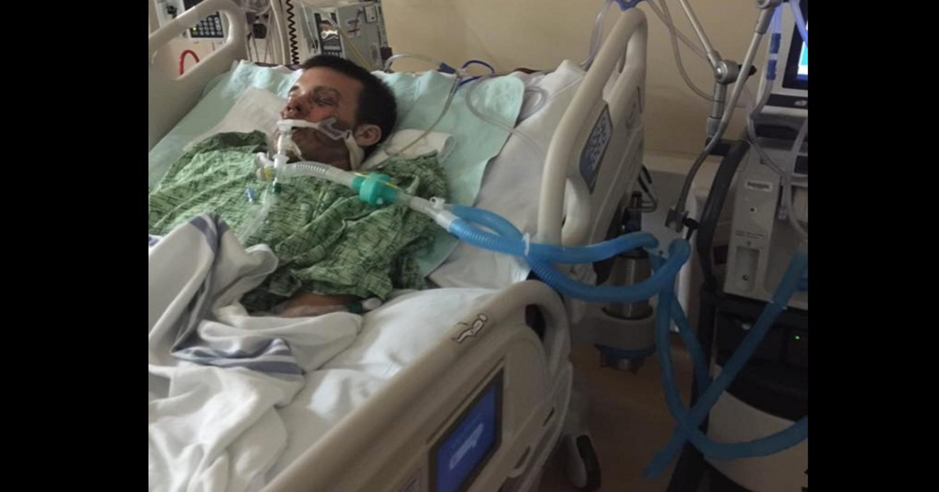 Fla Man Hospitalized After E Cigarette Explodes In Face