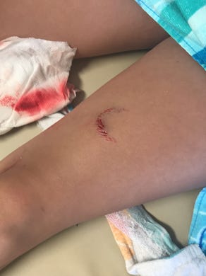 Adyson McNeely of Seymour was bit by a shark while