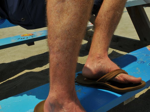 Ralph Sammis of Melbourne Beach talks about getting bitten by a Black-tip shark while surfing in South Melbourne Beach on April 21st 2003, the injury required nearly 100 stitches and three months in rehab .