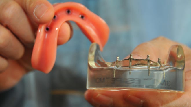 Dr. Richard Leong, Jr., has a comprehensive dentistry practice in Melbourne, specializing in difficult cases and dental implants. Dr. Leong shows a clear model of the jawbone with the mini implants and the denture that will fit over the implant.