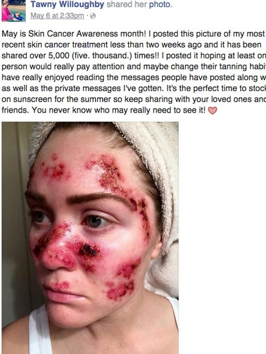 Woman shares graphic scars from skin cancer treatment