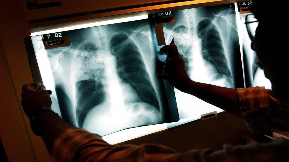 Tuberculosis Outbreak in Long Beach Prompts Public Health Emergency Declaration