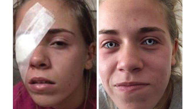 Zombie Contacts Damage Teen S Eye